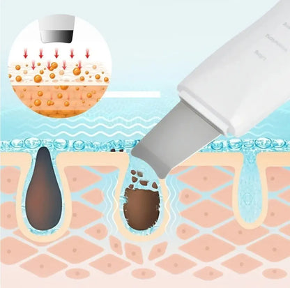 Espátula Facial Peeling Ultrasónica Exfoliante Limpiador