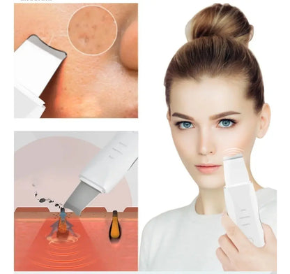 Espátula Facial Peeling Ultrasónica Exfoliante Limpiador